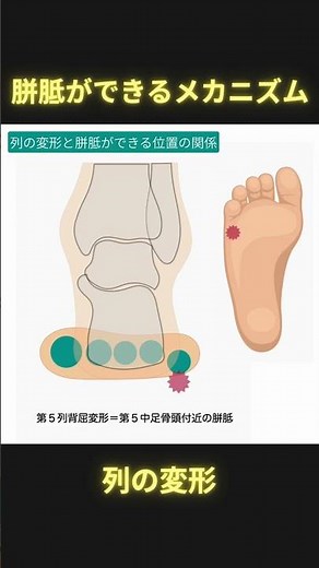 胼胝ができるメカニズム：列の変形 #理学療法 #ptタイガー #足病学