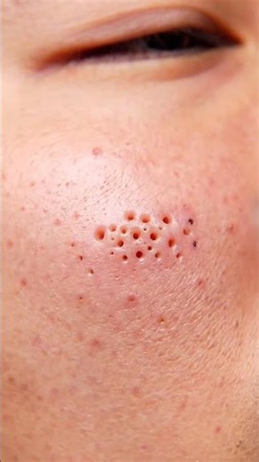 Deep Blackhead Pull — Ultra Satisfying