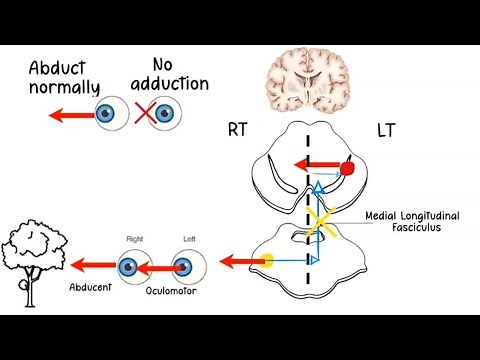 Internuclear Ophthalmoplegia INO ( one and half / eight and half syndrome)