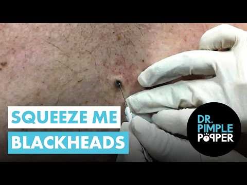 Satisfying Blackhead Squeeze