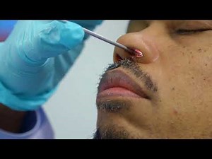 Patient of Dr. Azer at ENTA and Dr. Govindaraj at Mount Sinai Free of Sinus Tumor