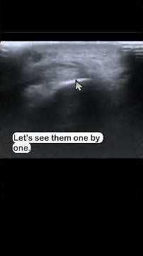 de Quervain tenosynovitis on ultrasound