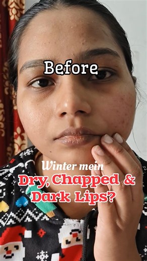 3 Days to Fix Dry, Chapped & Dark Lips This Winter ❄️👄 #shorts #diylipcare #pinklips #winterskincare
