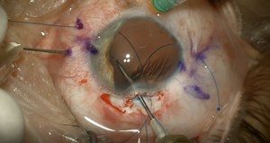 Traumatic Iris/Lens Loss - Eyetube