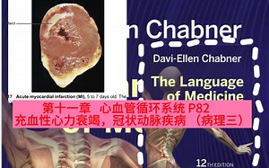 倒计时8天！chapter11:congestive heart failure and coronary heart disease P82