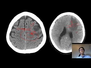 como diferenciar edema vasogênico do citotóxico