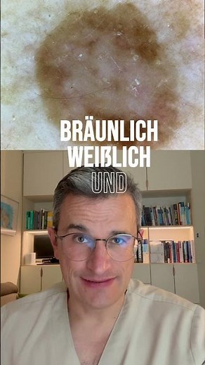 🎯 Dysplastic nevus: Benign – but not harmless! ⚠️