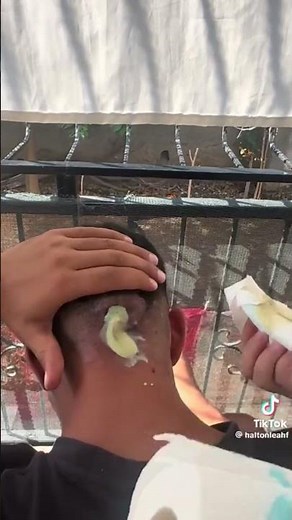 Head cyst drainage 💦💦