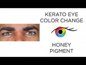 Eye Color Change from Dark to Light Brown with Kerato (Honey Pigment)