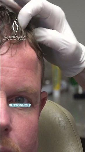Endoscopic Forehead Osteoma Removal: Dr. Niamtu's Case #cosmeticsurgeon #medicaleducation #osteoma