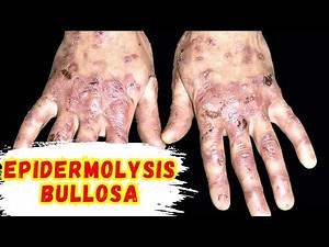 Epidermolysis Bullosa EXPOSED What's REALLY Happening to People with Butterfly Skin
