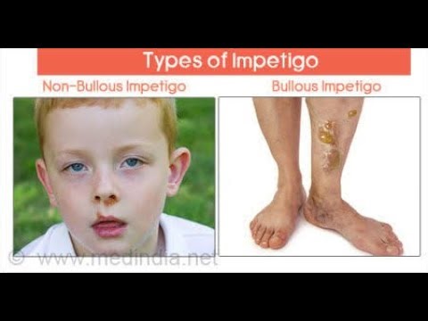 Differences Between Impetigo contagiosa (Non Bullous) And Bullous impetigo