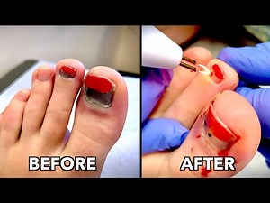 BURNING HOLES IN BLOOD FILLED TOE NAILS...(We Had to Relieve the Pressure) | Dr. Paul