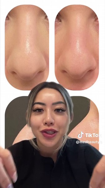 Nose Botox Injections