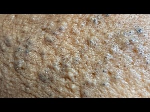 Every day relaxing removal black heads