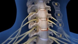 5.2K views · 15 reactions | Anterior cervical discectomy and fusion (ACDF) is a surgery to remove a herniated or degenerative disc in the neck. Watch below to know how the disc is removed and a graft is inserted to fuse together the bones above and below the disc. #ACDF #CervicalFusion #Surgery #India #NeckSurgery #FreeConsultation #IndiaHealthHelp | India Health Help | Facebook