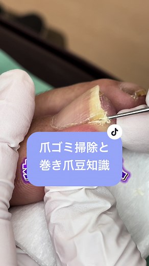 巻き爪治療方法と予防テクニック