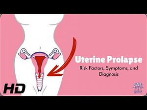 Uterine Prolapse: Treatment Options and Recovery Tips!