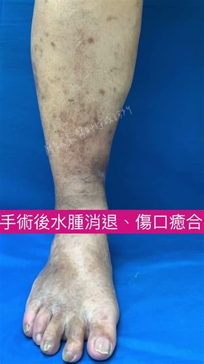 靜脈曲張手術