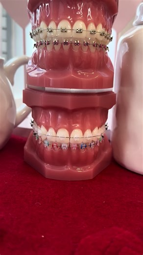 Braces Options: Metal, Gold, or Clear Ceramic?