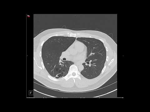 Congenital Lung Anomalies