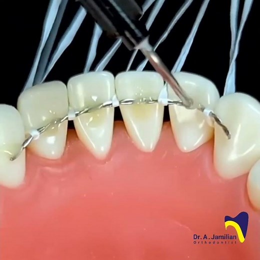 Fixed Retainer Procedure #dentist #orthodontist#Fixed_retainer#braces #retainer#retention#lingual