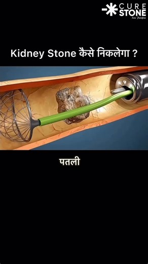 Cure Stone on Instagram: "POV: You’re a kidney stone and there’s nowhere to run. 🚫🛑 Watch this Anti-Retropulsion technique in action! 👇 When using a Lithoclast (which works like a tiny jackhammer), the force of the impact can actually shoot the stone back up the ureter and into the kidney. That turns a simple procedure into a complex one. The Solution? Surgeons place a wire basket behind the stone first. It acts as a backstop or a goalie. 🥅 ✅ The probe hits the stone. ✅ The basket catches th