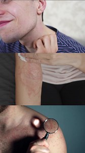 10K reactions · 127 shares | Break free from itchy, flaky skin! Introducing PsoriaSet - a potent essential oil blend that soothes psoriasis naturally. • Calms redness & dryness • Promotes skin healing • 100% natural & chemical-free Say goodbye to irritation and hello to radiant skin! Try now and feel the difference. Order Now → | Sukooon | Facebook