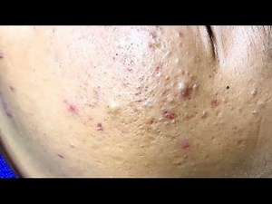 Professional Acne Extraction Treatment – Deep Blackhead & Comedone Removal