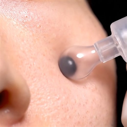 PoreWhisper on Instagram: "Removing stubborn blackheads the satisfying way #blackheads #skincarevideos Real clinic-style skincare — clean, calm, and ultra-realistic ❤️ #blackheads #blackheadremoval #skincare #pimplepopping #extraction #satisfyingvideos #skincareroutine #deepcleansing #facialtreatment #skincareclinic #estheticianlife #dermatologist #clearskin #skincarevideos #pores #skincarelover #blackheadextraction #skincareobsessed #beautycare #skincaregoals #reels #reelsskincare #reelstrendin
