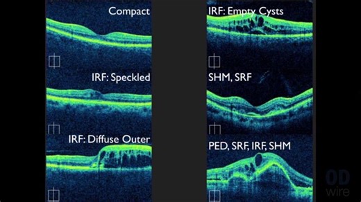 Macular OCT Interpretation: A Practical Discussion with Dr. David E… | Amaobi Ogbonna