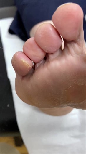 Unravel the secret of little toe pinch callus removal !. . . . #footpain #plantarfasciitis #heelpain #podiatry #footcare #podiatrist #orthotics #feet #foothealth #kneepain #foot #running #anklepain #backpain #bunions #flatfeet #healthyfeet #footpainrelief #arthritis #health #footdoctor #bunion #fyp #foryou #viralreels #explore | Docpods Treatment