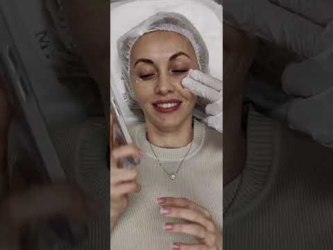 Thread placement in the periorbital area. The video uses 30g/25mm polydioxanone monofilaments.