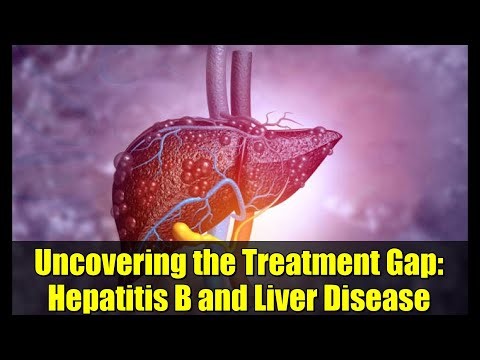 Uncovering the Treatment Gap: Hepatitis B and Liver Disease