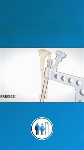 Wie wird eine Beinverlängerungsoperation mit Precice 2 durchgeführt?