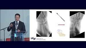 Managing the Complex Cases - Geriatric Distal Radius (Tips & Tricks)