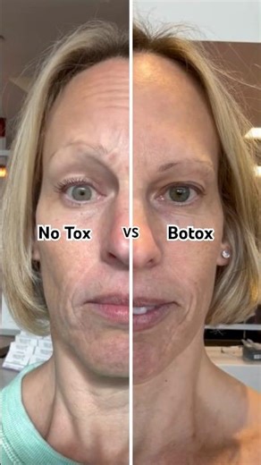 Botox vs No Tox: Before and after Botox injections 💉