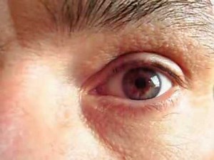 Congenital nystagmus