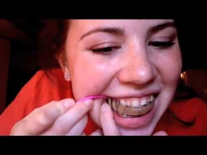TMJ Surgical Splint Demo (Part 2)