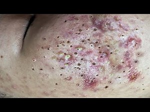 Blackhead Removal With Sac Dep Spa @100074609