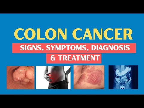 Colon Cancer (CRC) Signs & Symptoms Most People IGNORE | Intestinal Cancer Diagnosis & Treatment