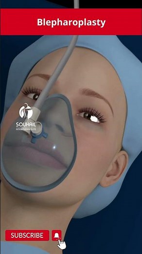 Blepharoplasty procedure