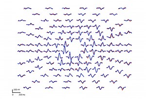 VEP Testi - ERG Testi Nedir? - Doç. Dr. Fatih Çakır Gündoğan -Kayseri