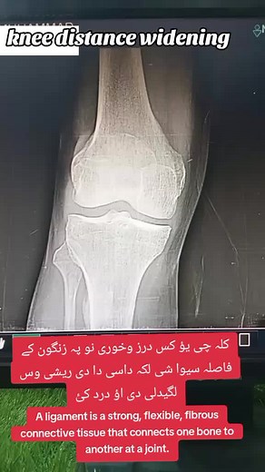 Understanding Ligaments: Functions and Common Injuries