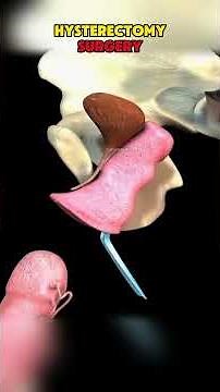 Hysterectomy Surgery For Uterus Removal #hysterectomy #uterusremoval #uterinefibroid #endometriosis