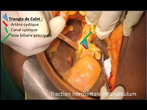 Open cholecystectomy / Cholécystectomie rétrograde par laparotomie