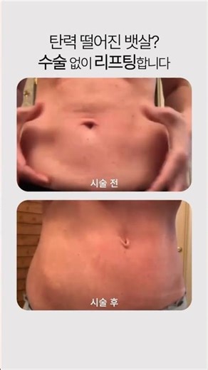 탄력 떨어진 뱃살? 수술 없이 리프팅합니다