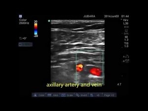 PEC1+PEC2 block+ T2&T3 intercostal nerve block