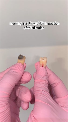 Patel dental & implant centre on Instagram: "15+ years of experience, thousands of implants, one standard: excellence 🦷 (Tooth Extraction,Surgical Extraction,Impacted Wisdom ,Tooth Surgery Minor Oral Surgery Major Oral Surgery Alveoloplasty Frenectomy (Lip / Tongue Tie) Biopsy (Oral Lesion Biopsy) Cyst Removal Tumor Removal) (Dental Implant Surgery Single Tooth Implant Multiple Teeth Implant Full Mouth Implant Immediate Implant Placement Delayed Implant Placement Basal Implant Surgery Zygomatic