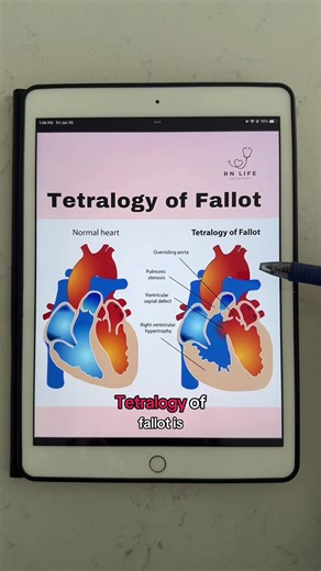 Congenital Heart Defect TOF Explained for NCLEX Prep